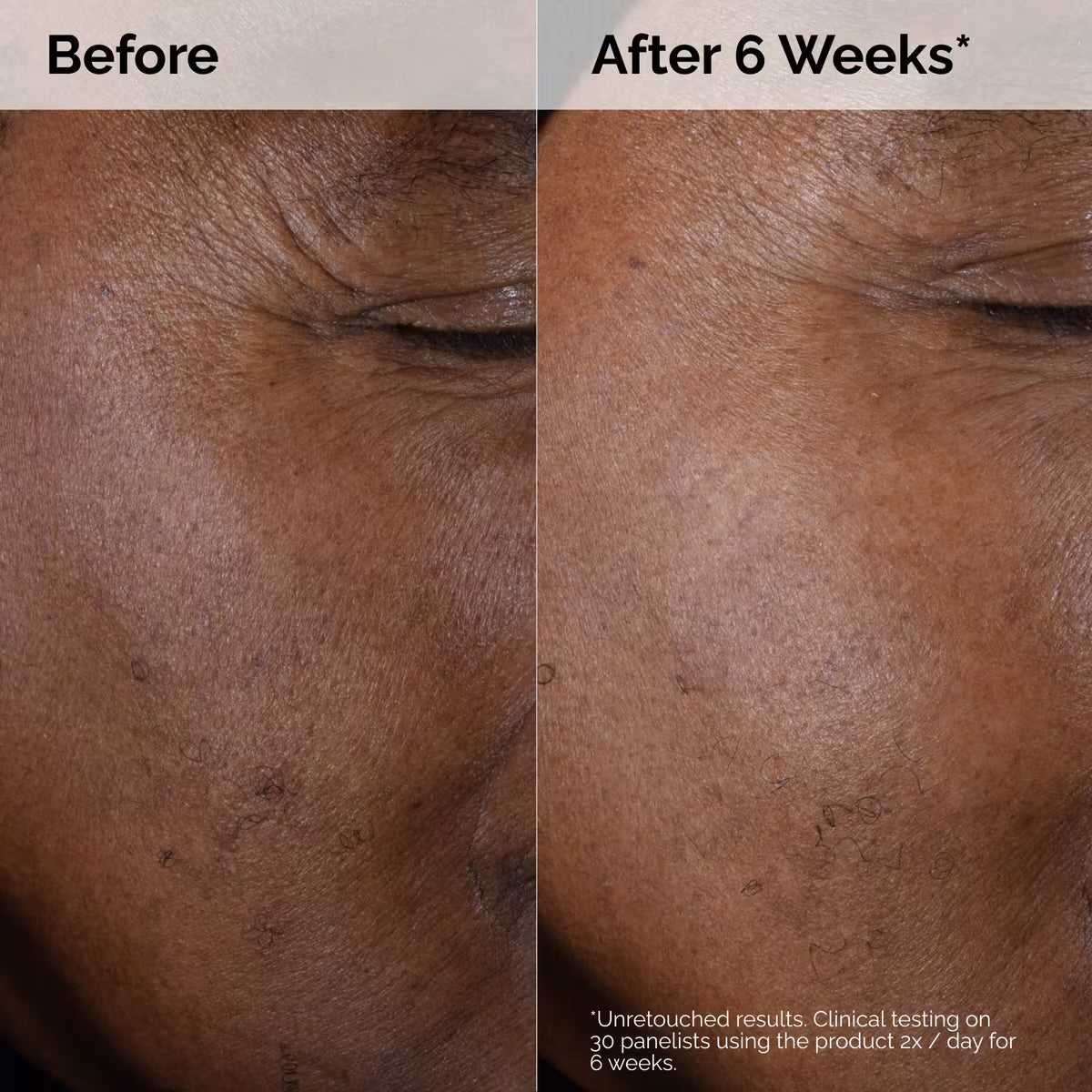 The Ordinary Glycolic Acid for Acne Marks and Scars
